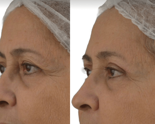 viladerma-blefaroplastia-01