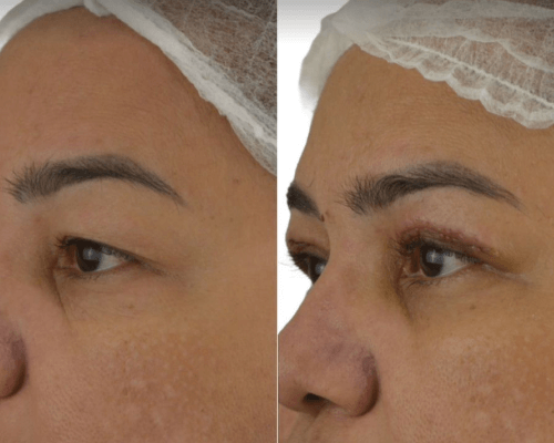 viladerma-blefaroplastia-02