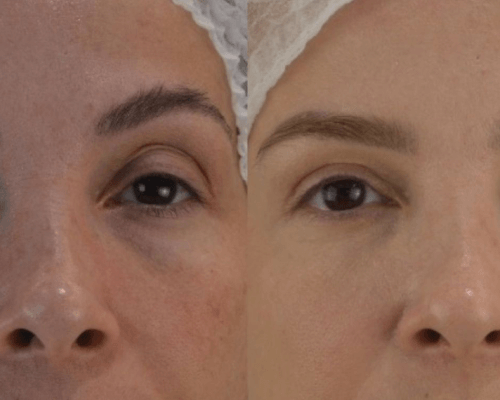 viladerma-blefaroplastia-03