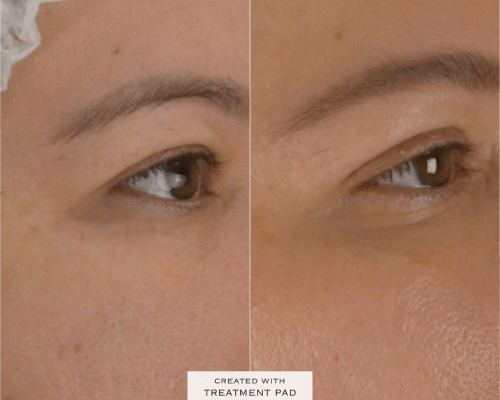 viladerma-blefaroplastia-04