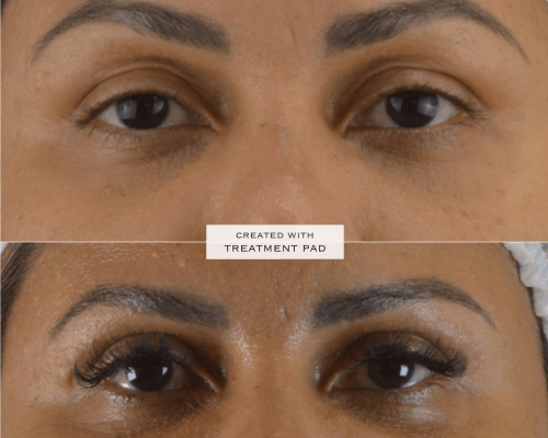 viladerma-blefaroplastia-05